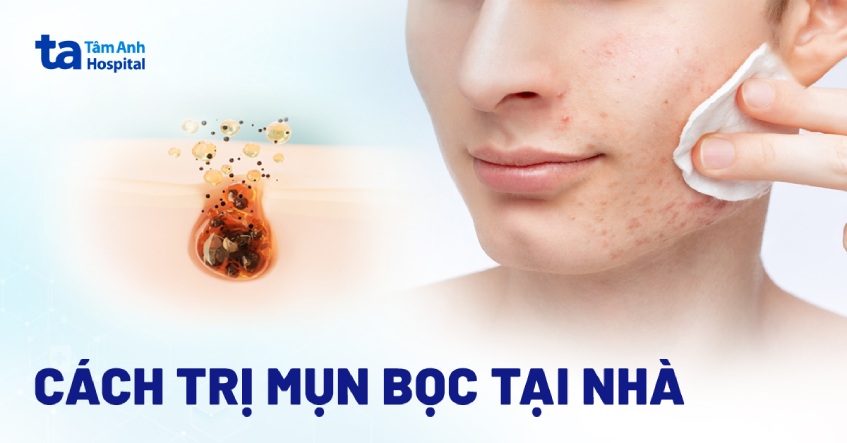 Có Nên Nặn Mụn Bọc? Gallery 2