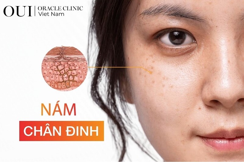 Nám chân đinh có chữa được không? Gallery 2