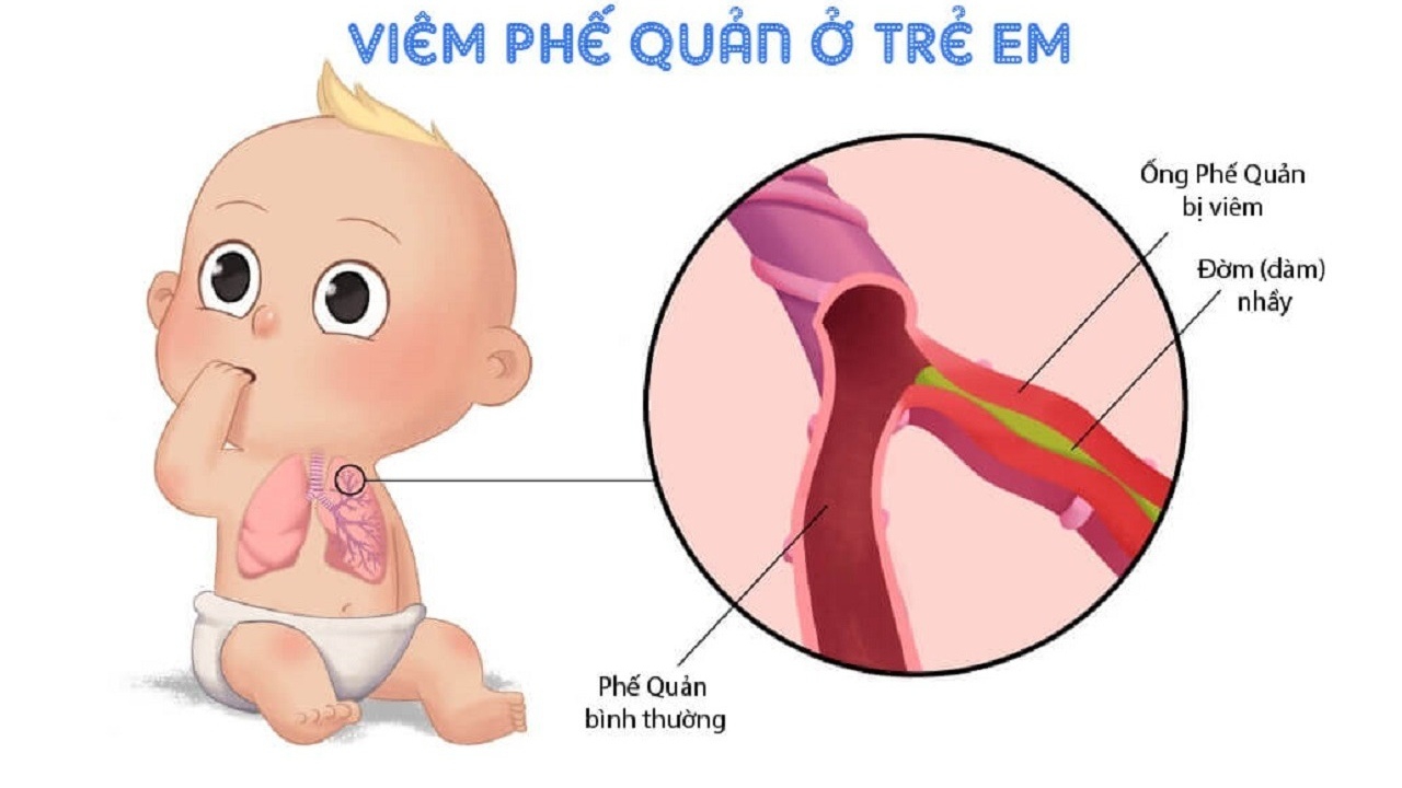 Cách Chữa Dứt Điểm Viêm Phế Quản Ở Trẻ Em Gallery 2