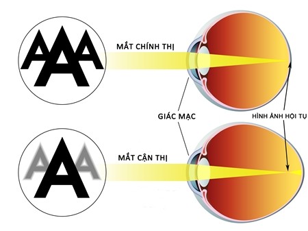 Khắc Phục Cận Thị Gallery 1