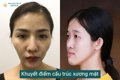 Gò má đầy đặn: Bí quyết sở hữu gương mặt phúc hậu và trẻ trung Gallery 2