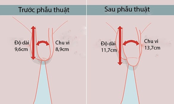 Tăng Kích Thước Dương Vật Tại Nhật Gallery 1