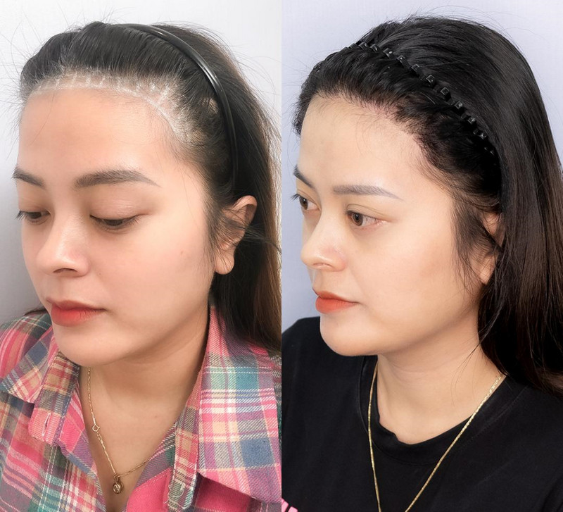 Cách Làm Trán Bớt Cao Gallery 2