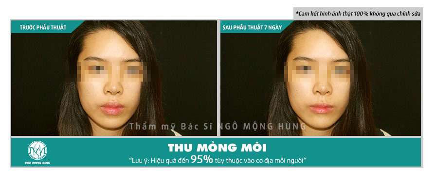 Thu gọn môi dày Gallery 1