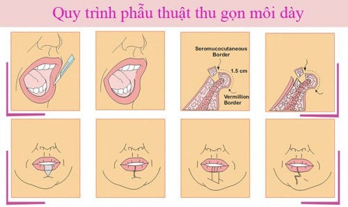 Cách Làm Môi Bớt Trề Gallery 1