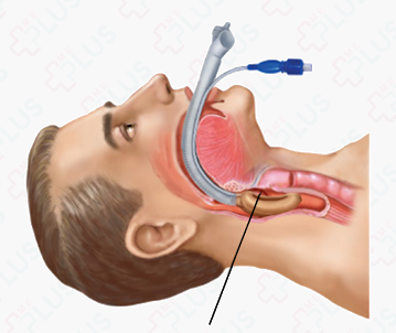 Phương Pháp Vô Cảm: Hướng Dẫn Chi Tiết