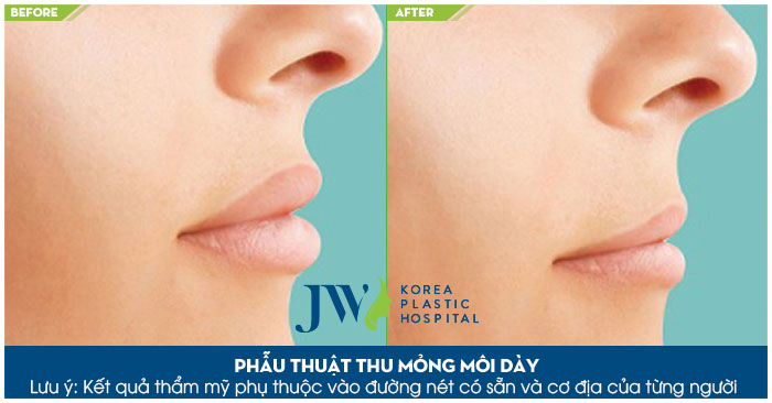 Cách Làm Môi Bớt Trề Gallery 2