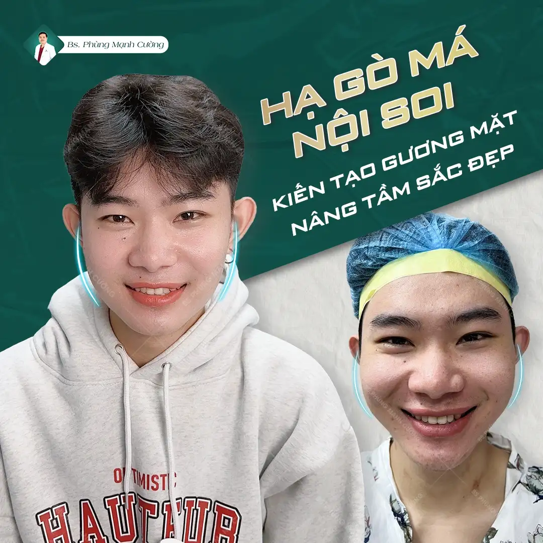 Hạ gò má bao lâu thì lành? Gallery 2