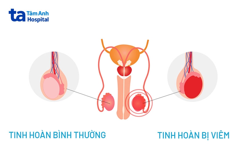 Quai bị bao lâu thì khỏi?