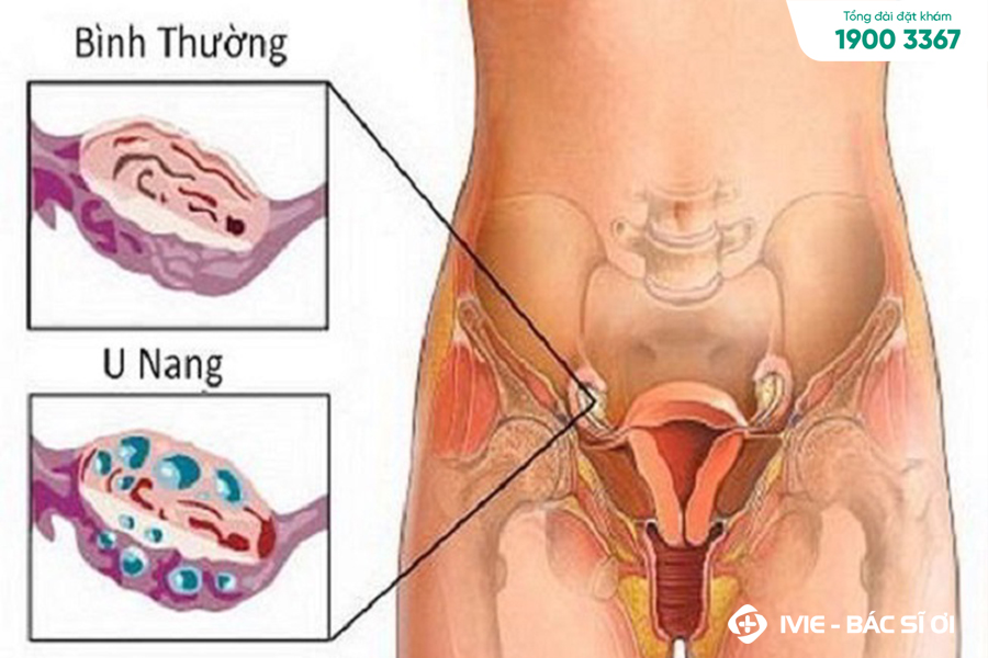 Quan Hệ Bị Thốn Bụng Dưới: Nguyên Nhân và Cách Khắc Phục