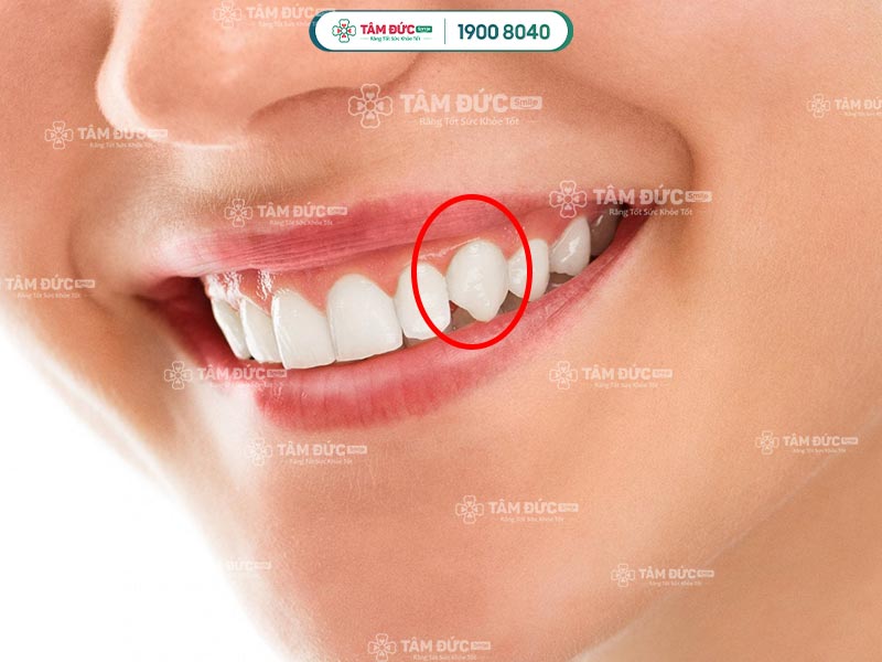 Người Có Răng Nanh Nhọn Là Người Như Thế Nào? Gallery 2
