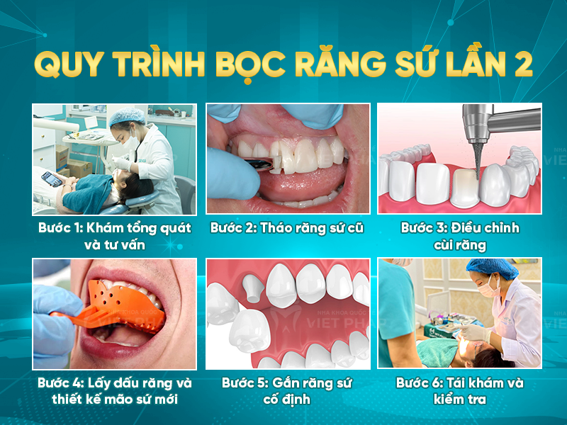Bọc Răng Sứ Lần 2: Khi Nào Cần & Những Điều Cần Biết Gallery 2