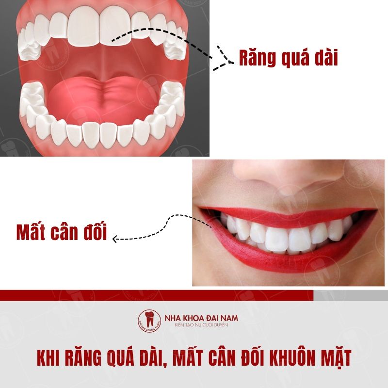 Mài Răng Cửa Ngắn Lại Gallery 2