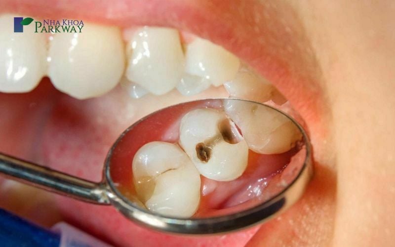 Răng hàm bị sâu lung lay có nên nhổ không? Gallery 2