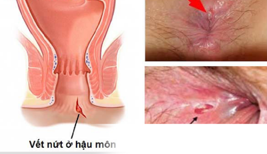 Rách hậu môn có nguy hiểm không?