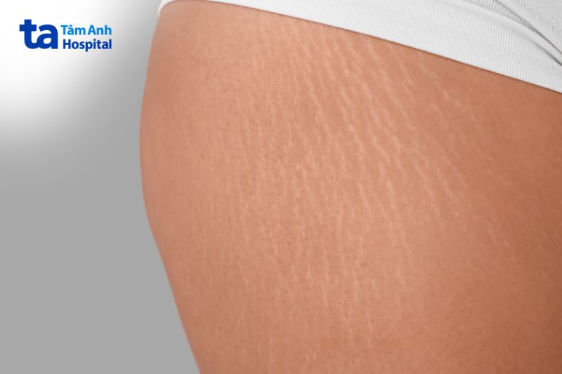 Rạn da ở đùi: Nguyên nhân, cách điều trị và phòng ngừa