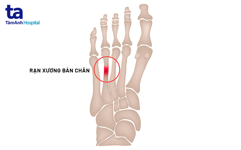 Rạn xương bàn chân bao lâu thì khỏi?