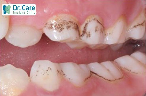 Răng bị đen ở kẽ: Nguyên nhân và cách khắc phục