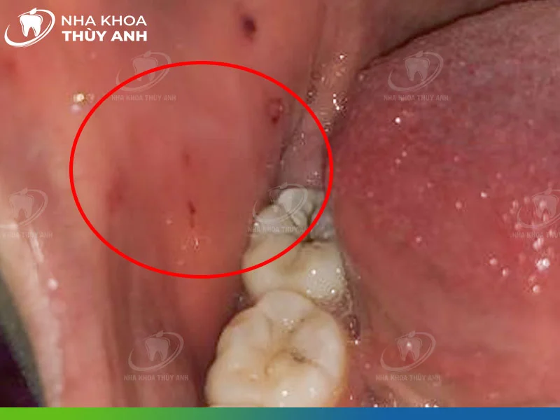 Răng cắn vào má trong: Nguyên nhân và cách khắc phục