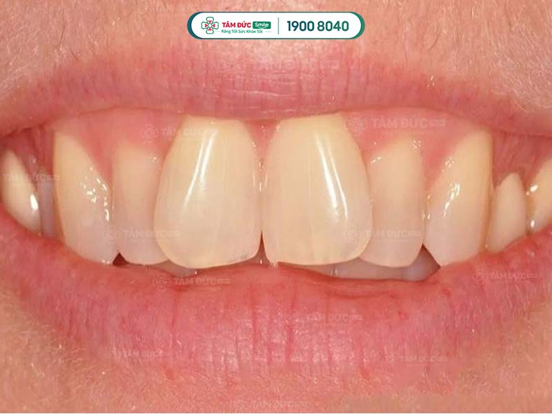 Răng Cánh Bướm Đẹp