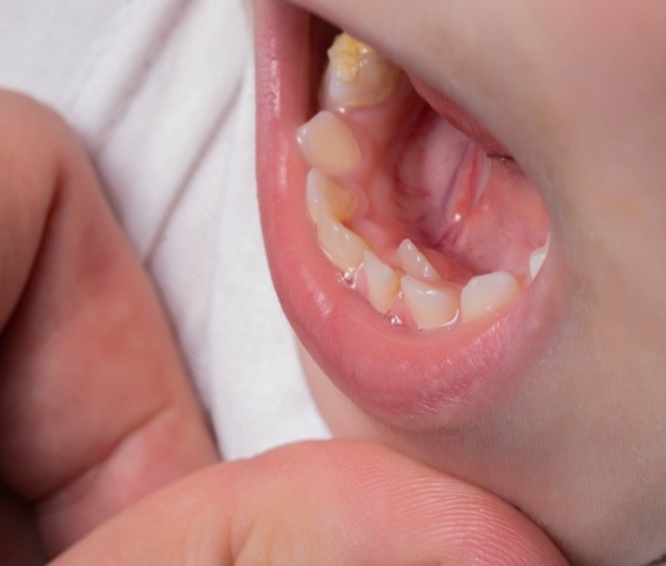 Răng Chưa Lung Lay Đã Mọc: Nguyên Nhân Và Cách Xử Lý