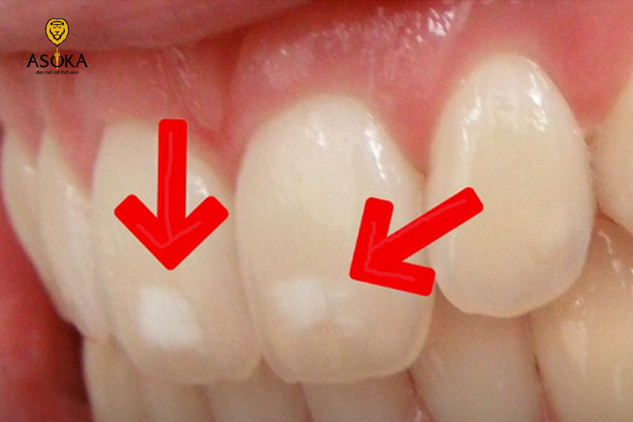 Răng có vệt trắng là gì? Nguyên nhân và cách khắc phục