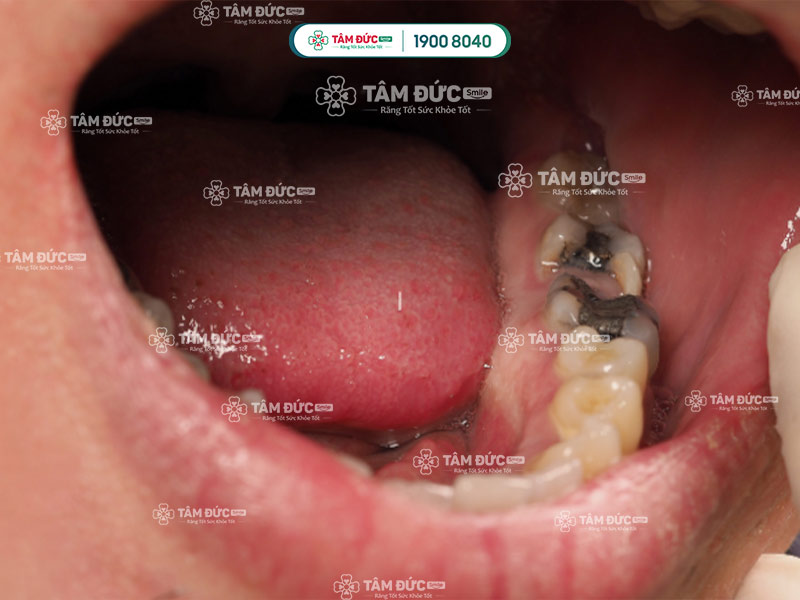 Răng cối bị sâu: Nguyên nhân, triệu chứng và cách điều trị
