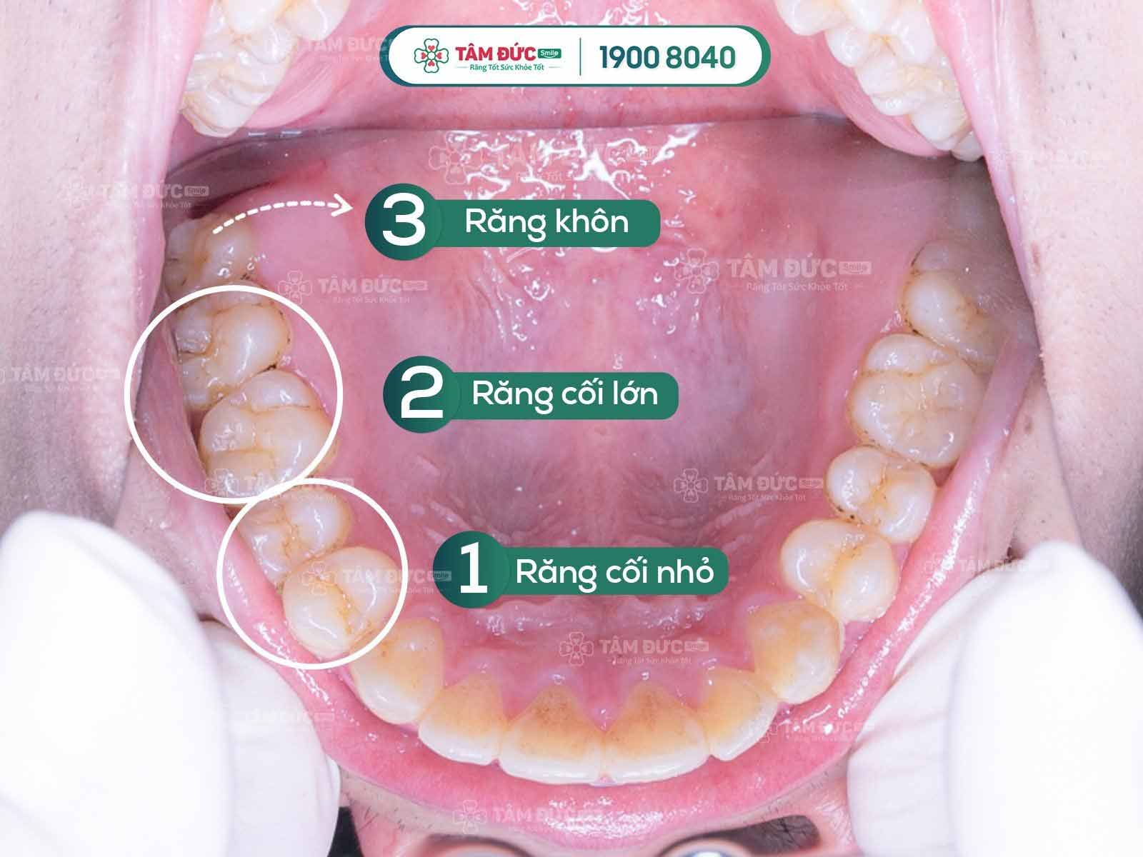 Răng cối sữa có thay không?