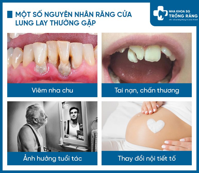 Răng cửa lung lay: Nguyên nhân, triệu chứng và cách xử lý