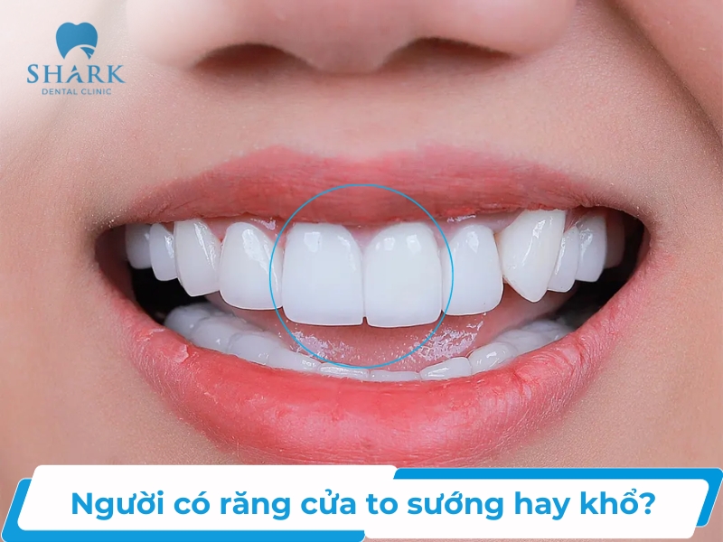 Răng cửa to sướng hay khổ?