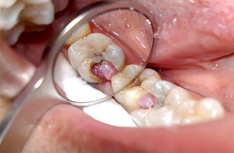 Răng hàm bị sâu lung lay có nên nhổ không?