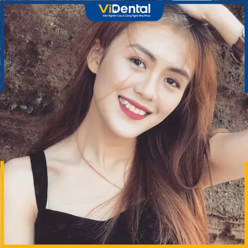 Con Gái Có Răng Khểnh: Vẻ Đẹp Ngọt Ngào Hay Khiếm Khuất? Gallery 1