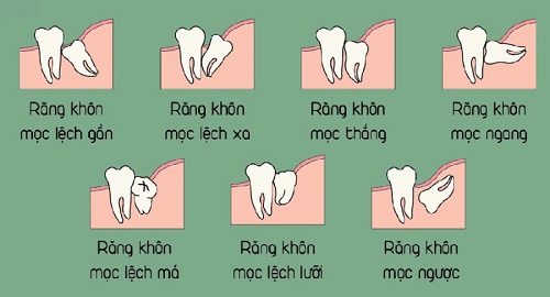Răng Khôn Có Mấy Chân?