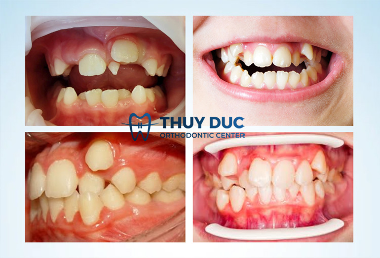 Răng mọc chồi trên lợi: Nguyên nhân, triệu chứng và cách xử lý