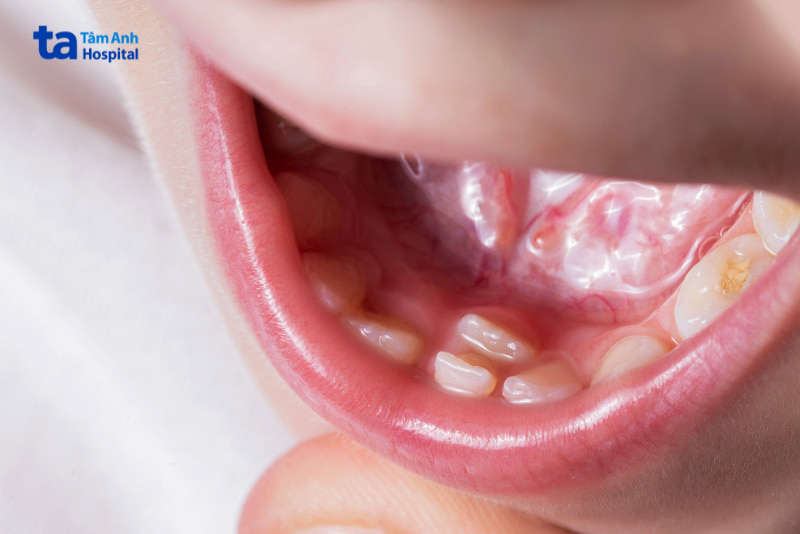 Răng Mọc Lẫy Hàm Dưới: Nguyên Nhân, Triệu Chứng Và Cách Khắc Phục