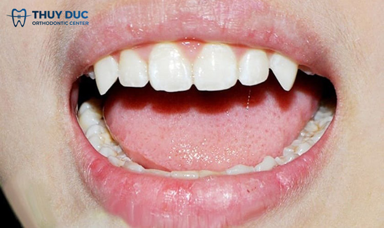 Răng Nanh Ở Người: Chức Năng, Đặc Điểm Và Những Vấn Đề Thường Gặp