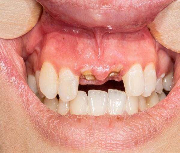 Răng sâu còn chân có nhổ được không?