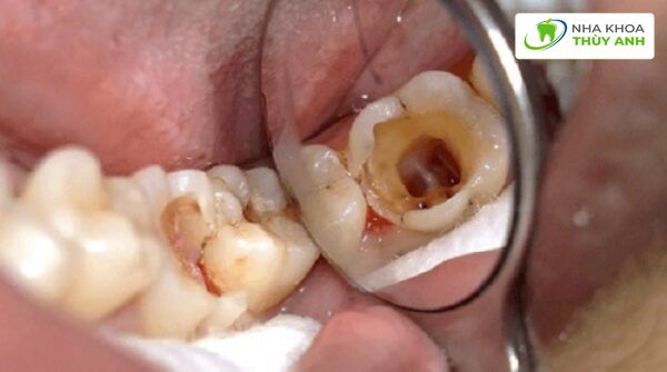 Răng số 6 bị lung lay đau nhức: Nguyên nhân, điều trị và phòng ngừa