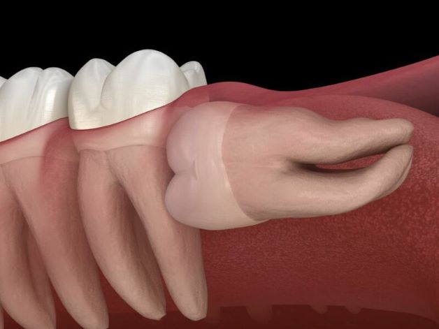 Răng Số 8 Mọc Ngang: Nguyên Nhân, Biểu Hiện & Cách Khắc Phục