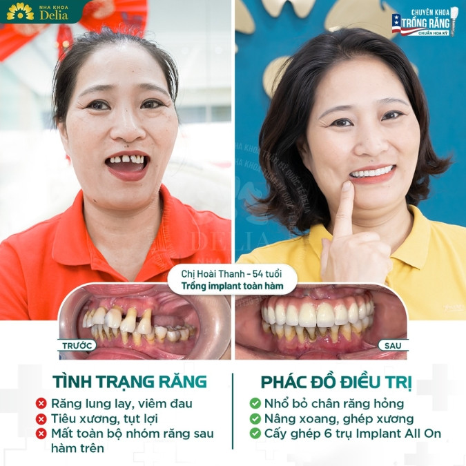 Răng Sứ Khi Về Già: Giữ Nụ Cười Rạng Rỡ Tuổi Tàn