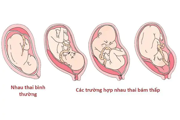 Rau bám thấp có nguy hiểm không?