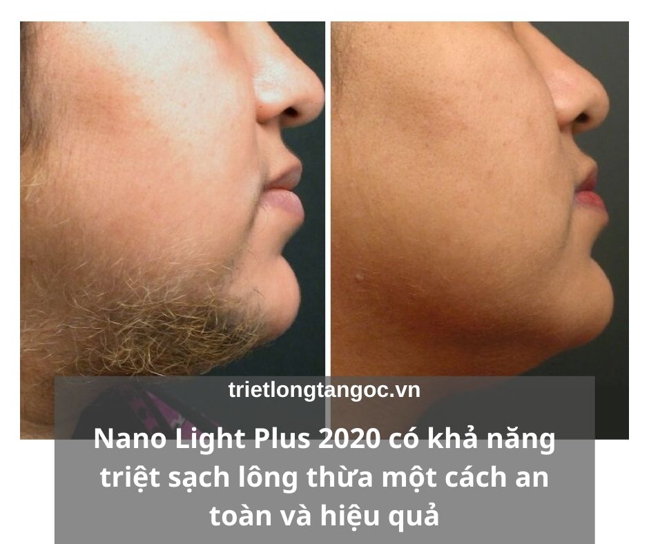 Râu mọc ở cổ: Nguyên nhân, cách điều trị và phòng ngừa