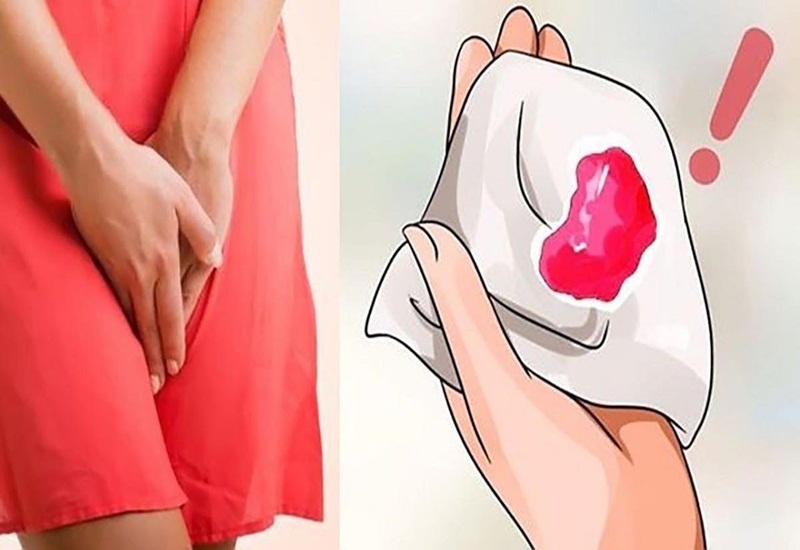 Rỉ Máu Vùng Kín: Nguyên Nhân, Triệu Chứng Và Cách Xử Trí