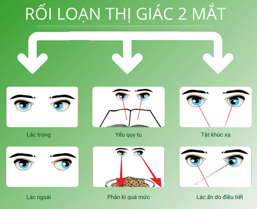 Sự điều tiết của mắt là gì? Gallery 2