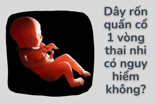 Rốn quấn cổ 1 vòng