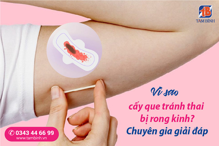Cấy que bị rong kinh bao lâu? Gallery 1