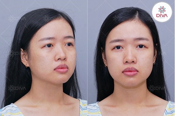Rũ Mắt Là Gì? Nguyên Nhân Và Cách Khắc Phục