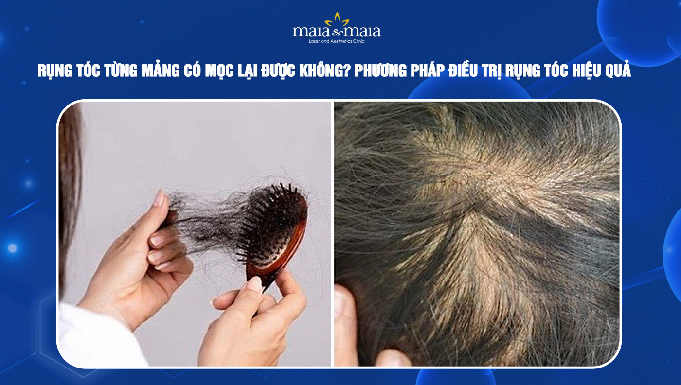 Rụng tóc từng mảng có mọc lại được không?