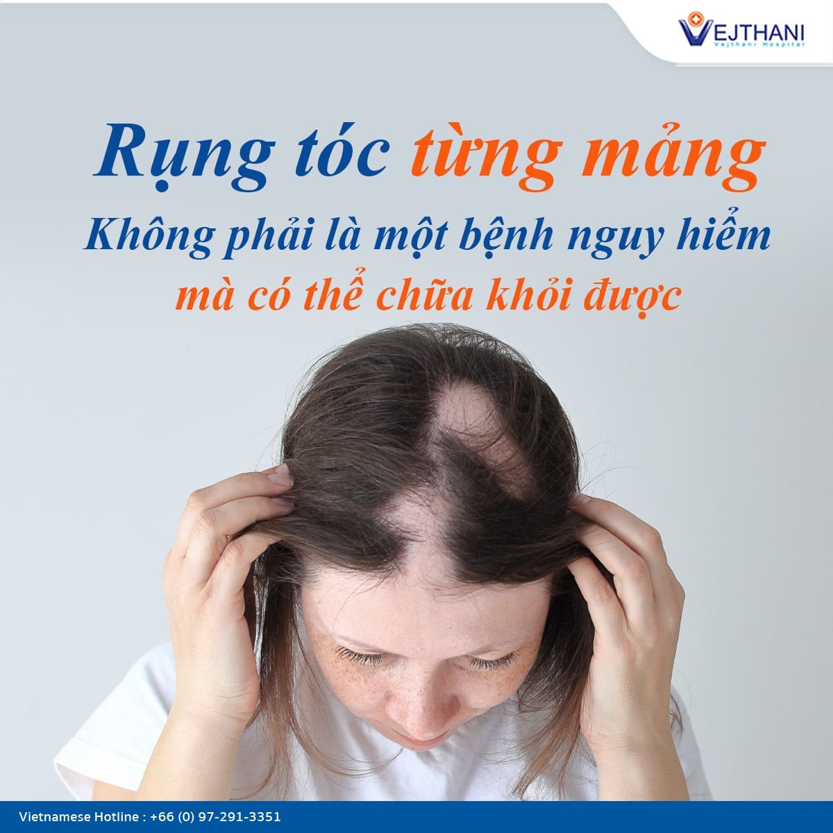 Rụng tóc từng mảng có nguy hiểm không? Gallery 2