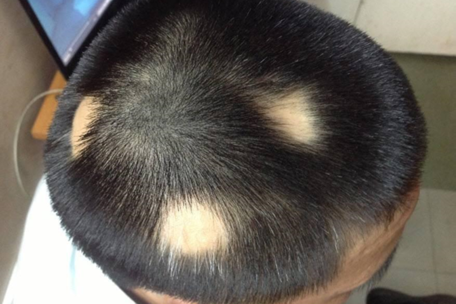 Rụng tóc từng mảng có nguy hiểm không? Gallery 1